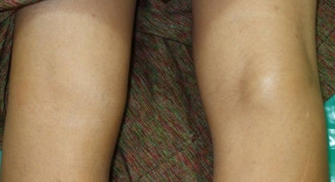 Киста Бейкера коленного сустава: как лечить кисту под коленом (фото)