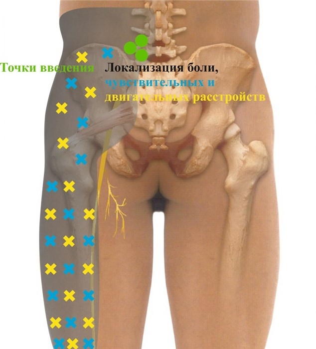 Что такое блокада коленного сустава (плечевого, локтевого, тазобедренного): лечение уколами препаратов (Дипроспан)