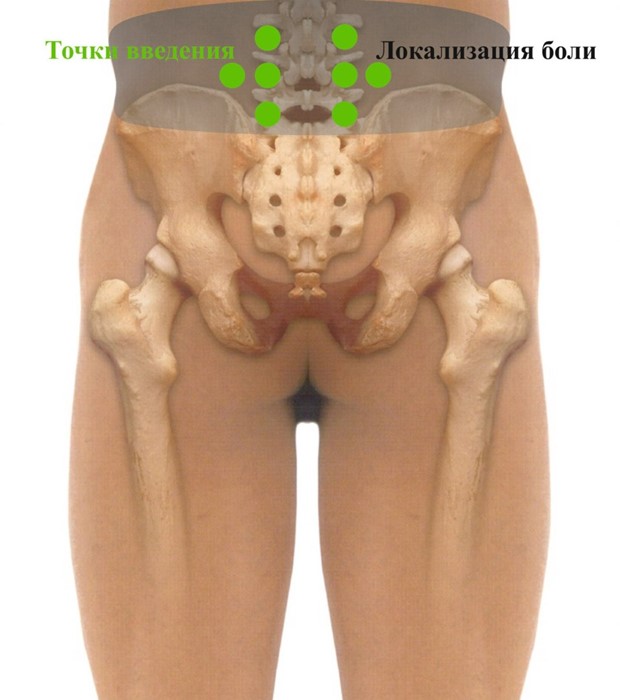 Что такое блокада коленного сустава (плечевого, локтевого, тазобедренного): лечение уколами препаратов (Дипроспан)