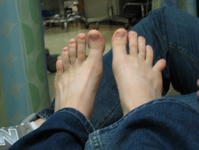 Вывих пальца на ноге