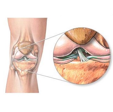 Диагноз лигаментоз коленного сустава: что это такое?