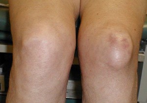 Лигаментит внутренней боковой связки коленного сустава