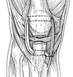 Лигаментит внутренней боковой связки коленного сустава