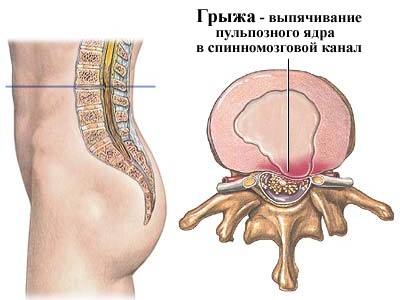 Методы лечения и признаки межпозвоночной грыжи грудного отдела