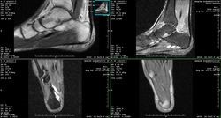 МРТ голеностопных суставов ног: томография суставов голеностопа