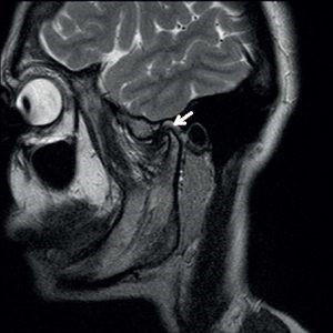 МРТ височно-нижнечелюстного сустава: томография челюстно-лицевого сустава