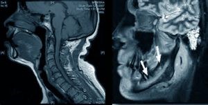 МРТ височно-нижнечелюстного сустава: томография челюстно-лицевого сустава