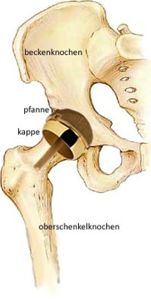 Эндопротезирование тазобедренного сустава: особенности крепления протеза