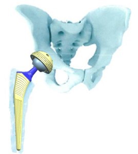 Эндопротезирование тазобедренного сустава: особенности крепления протеза