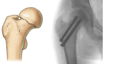 Оперативное лечение и реабилитация при переломе бедренной шейки