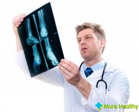 Симптомы и лечение перелома плюсневой кости стопы