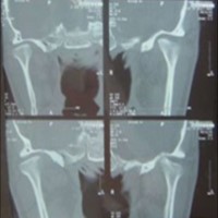Остеоартроз височно-нижнечелюстного сустава: лечение ВНЧС
