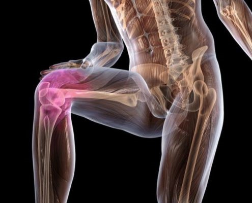 Как лечить остеопороз коленного сустава 1 степени