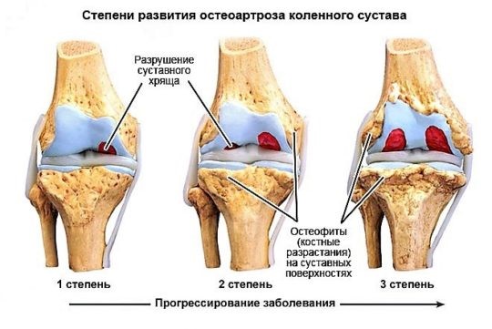 Остеопороз коленного сустава: симптомы и лечение колена
