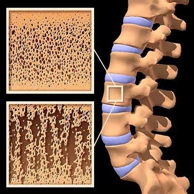 Полная характеристика остеопороза костей: симптомы, лечение, последствия болезни