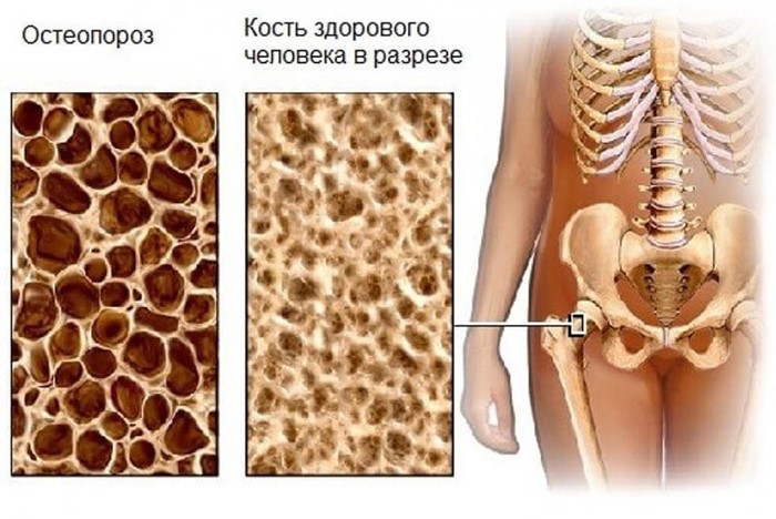 Лечение и профилактика остеопороза у женщин