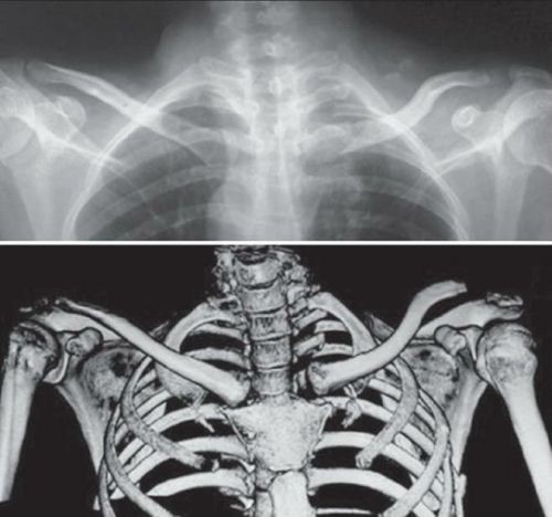 Анатомия грудино-ключичного сустава и его патологии