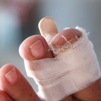 Признаки и лечение перелома большого пальца ноги