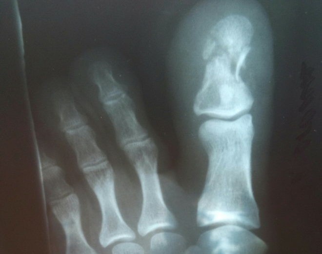Признаки и лечение перелома большого пальца ноги