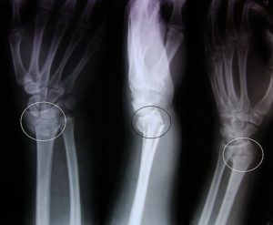 Виды и методы лечения переломов лучевой кости