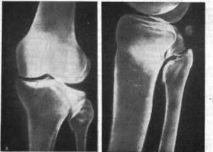 Типы переломов большеберцовой кости, и методы их лечения