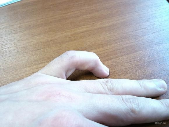 Причины и лечение перелома мизинца на руке