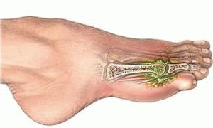 Признаки и лечение перелома пальца на ноге