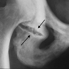 Анатомия и переломы седалищной кости