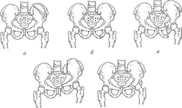Симптомы и лечение перелома лонной кости таза