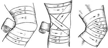 Колосовидная (косыночная) повязка на плечевой сустав: как наложить на плечо