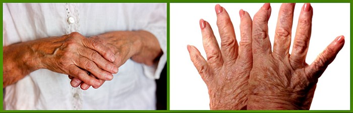 Подагрический артрит: симптомы и лечение острой формы при подагре