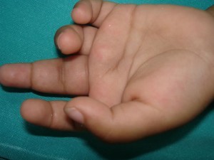 Ревматоидный артрит: причины возникновения у детей и взрослых