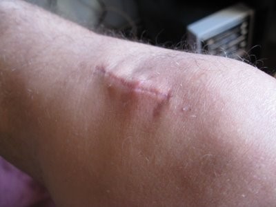 Повреждение передней крестообразной связки коленного сустава лечение