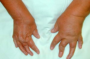 Псориатический артрит: симптомы и лечение в домашних условиях