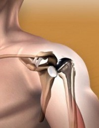 Эндопротезирование плечевого сустава: реабилитация с эндопротезом