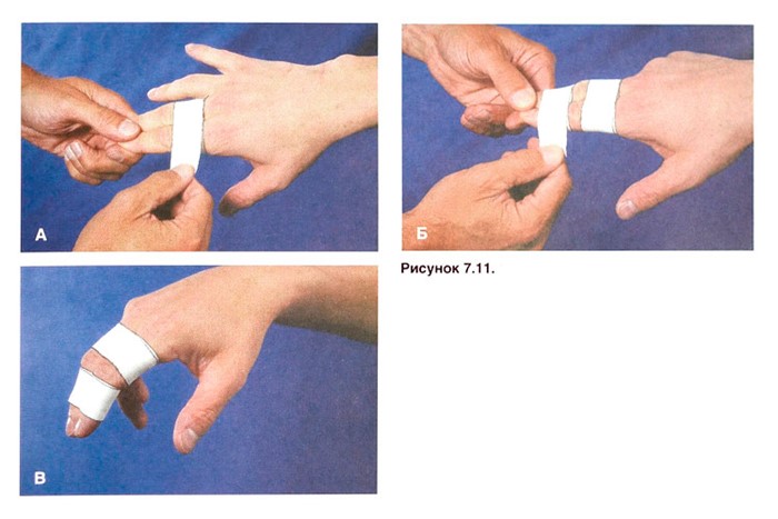 Разрыв связок на пальце руки