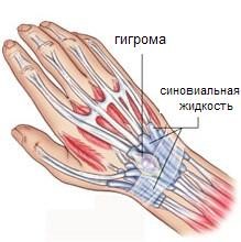 Гигрома на запястье руки: лечение и фото