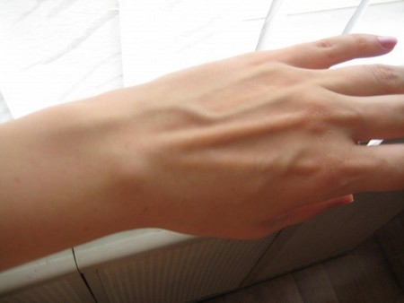 Гигрома на запястье руки: лечение и фото