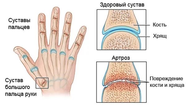 Почему болят и опухают пальцы рук: причины опухоли на руках