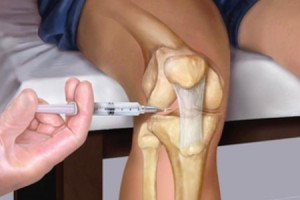 Препараты гиалуроновой кислоты для коленного сустава: обзор уколов для колена, отзывы об инъекциях