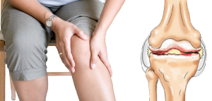 Препараты гиалуроновой кислоты для коленного сустава: обзор уколов для колена, отзывы об инъекциях