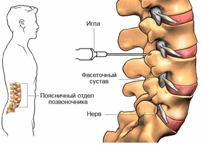 Как и какие уколы применяют при остеохондрозе поясничного отдела позвоночника?