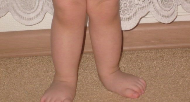 Плоско вальгусная деформация стоп у детей лечение