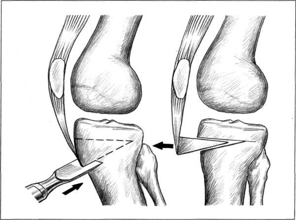 Когда и как проводится артроскопический дебридмент коленного сустава?