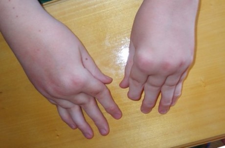 Ювенильный ревматоидный артрит: причины диагноза, симптомы (фото) и лечение у детей
