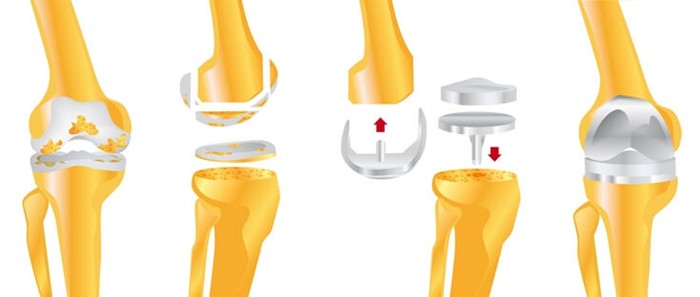 Операция по замене коленного сустава: показания, виды протезов, реабилитация