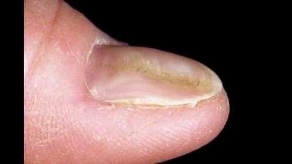 Деформация ногтевой пластины на руках причины