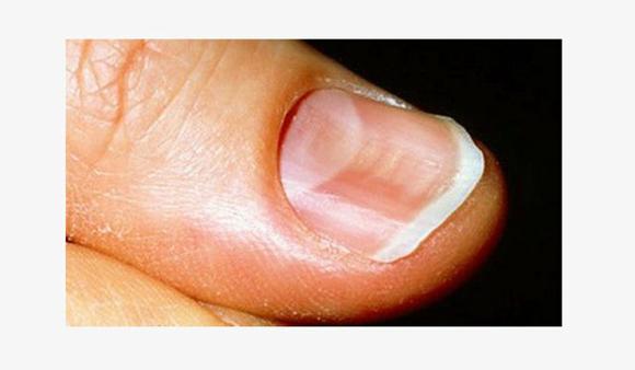 Деформация ногтя на большом пальце ноги